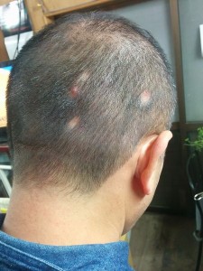 円形脱毛症の戦線拡大中