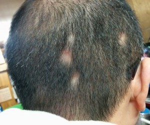 円形脱毛症の戦線拡大中