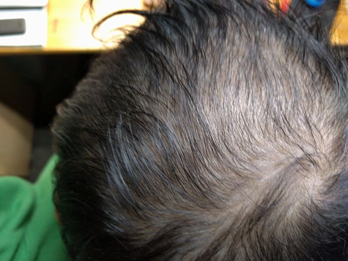 2016年元日のハゲの記録